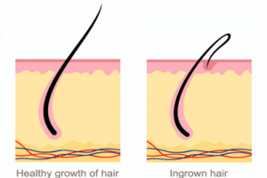 How To Remove Ingrown Hair Healthy Articles